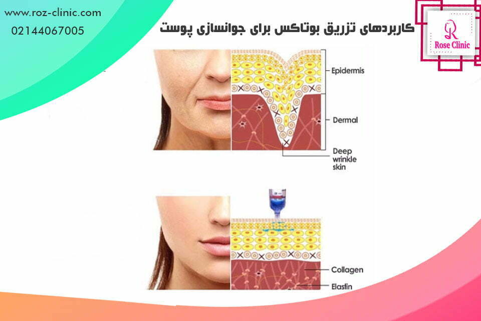 کاربرد های تزریق بوتاکس برای جوانسازی پوست