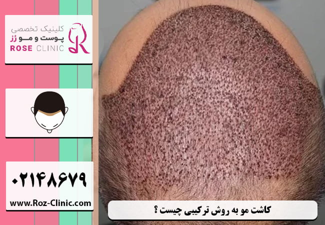 کاشت مو به روش ترکیبی در کلینیک تخصصی پوست و مو رز