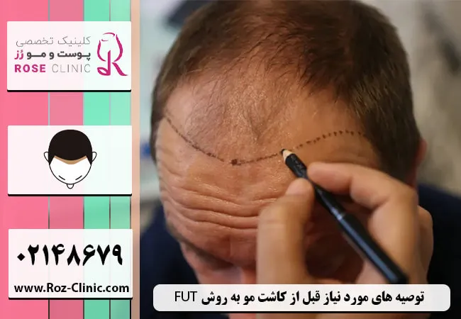 توصیه های قبل از کاشت مو به روش FUT