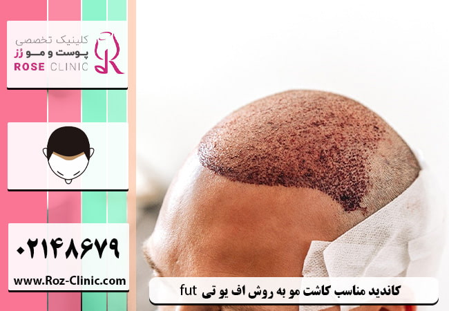 همه چیز درمورد کاشت مو به روش FUT در کلینیک پوست و مو رز
