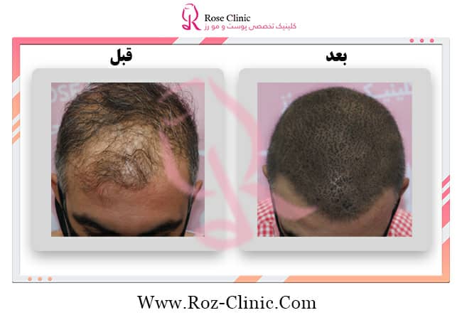 عکس بعد از کاشت مو در کلینیک تخصصی رز