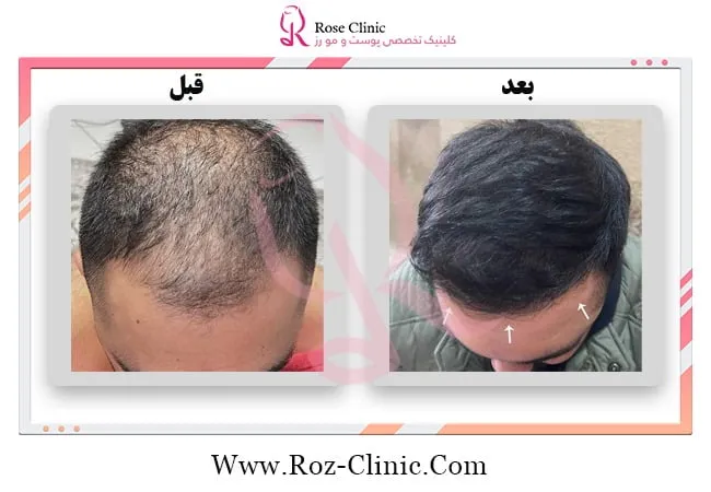 عکس قبل و بعد کاشت مو به روش سوپرترکیبی