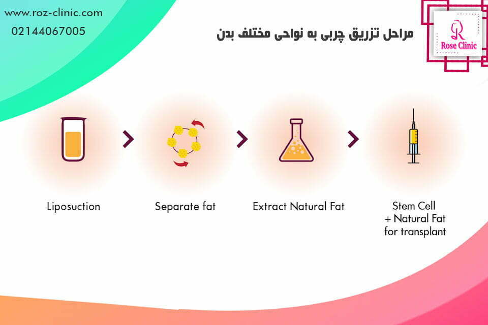 مراحل تزریق چربی به نقاط مختلف بدن