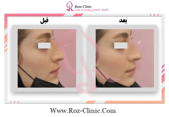 قبل و بعد از تزریق ژل به بینی کلینیک رز