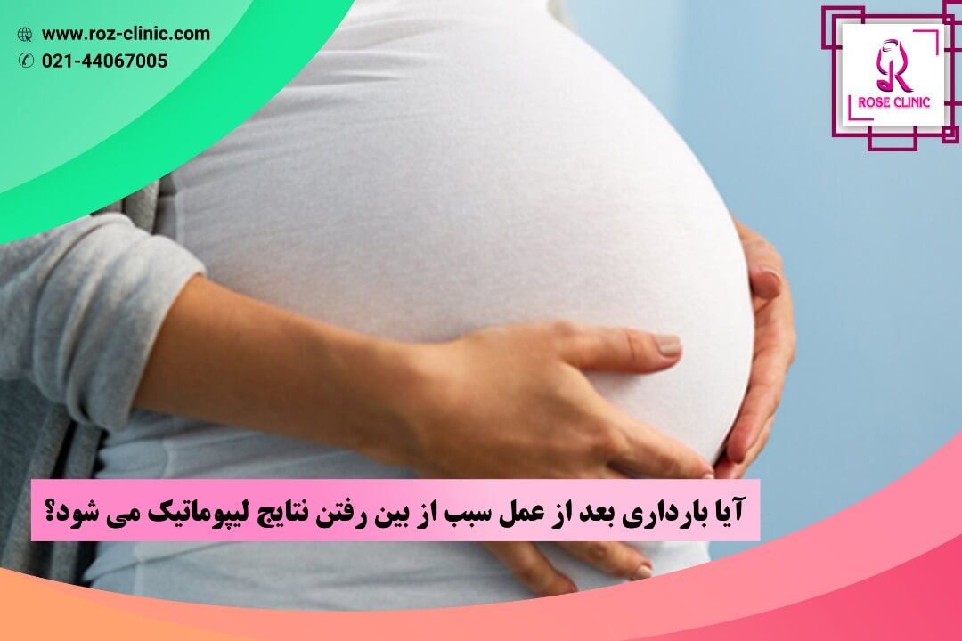 آیا بارداری بعد از عمل سبب از بین رفتن نتایج لیپوماتیک می شود؟