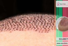 درمان و علت دلمه های بعد از کاشت مو