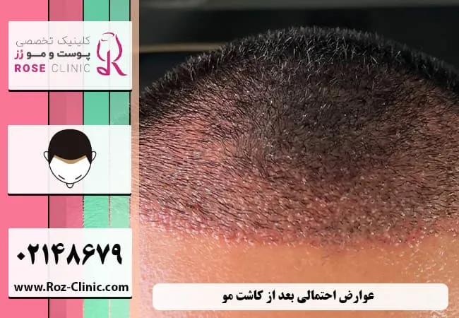 عوارض احتمالی بعد از پیوند موی طبیعی