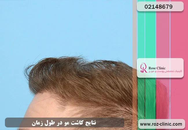 نتایج پیوند مو در طول زمان