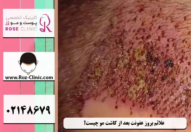 علائم بروز عفونت بعد از کاشت مو چیست؟