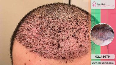 عفونت بعد از کاشت موی طبیعی