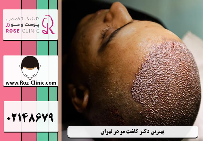 انتخاب بهترین پزشک کاشت مو در تهران