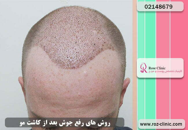 درمان جوش بعد از پیوند مو
