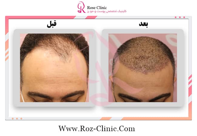 عکس قبل و بعد کاشت مو جدید و تخصصی