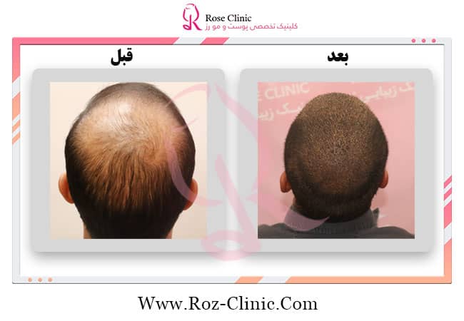 عکس قبل و بعد جدیدترین روش کاشت مو در کلینیک رز