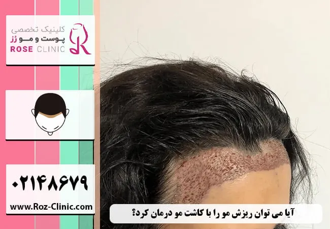 آیا می توان ریزش مو در زنان را با پیوند مو درمان کرد؟