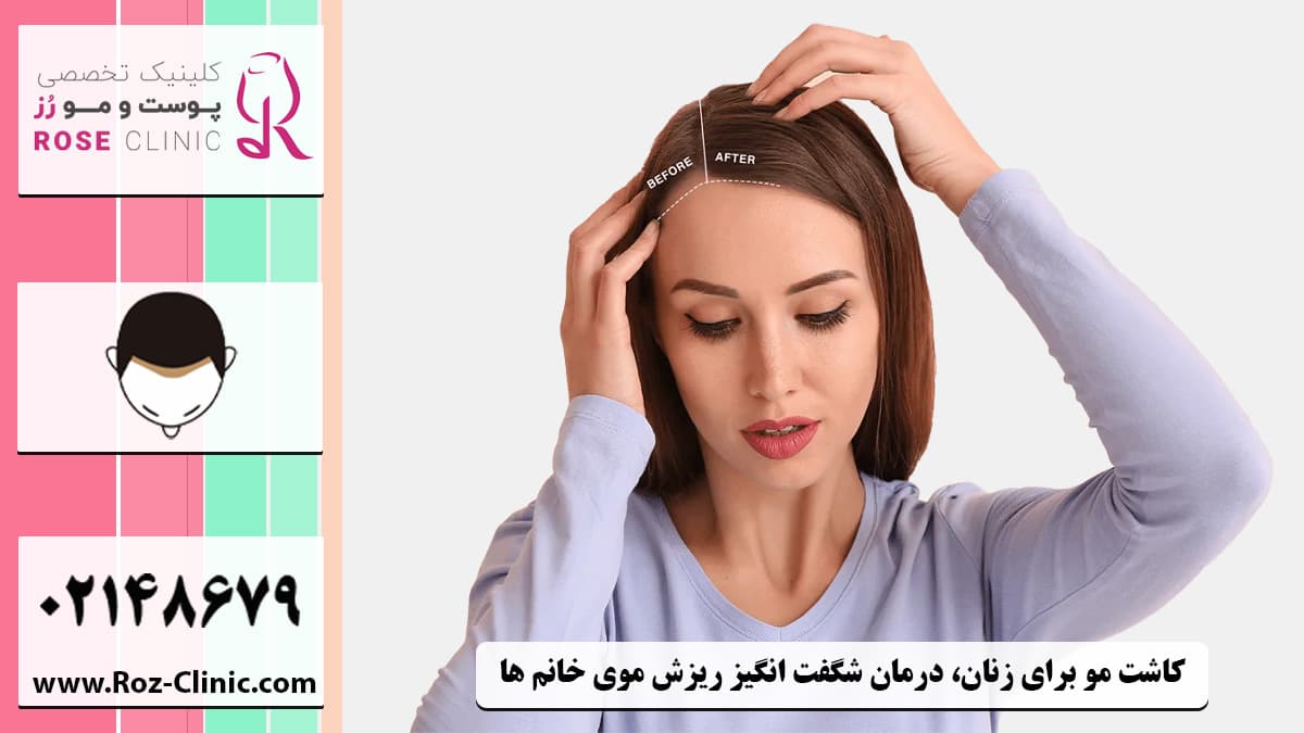 درمان ریزش مو در زنان با کاشت مو