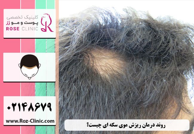 ریزش موی سکه ای- دلایل و روش درمان