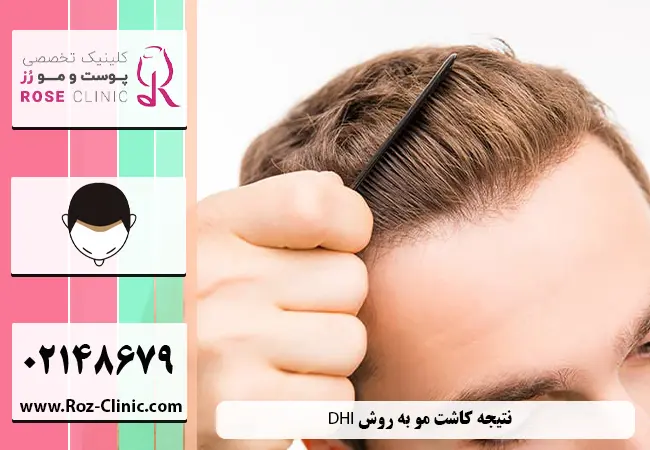 نتیجه کاشت طبیعی مو به روش DHI 