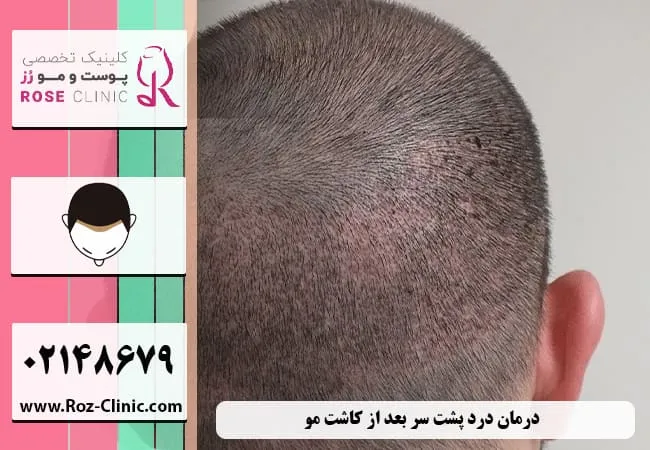 درمان درد پشت سر بعد از کاشت مو