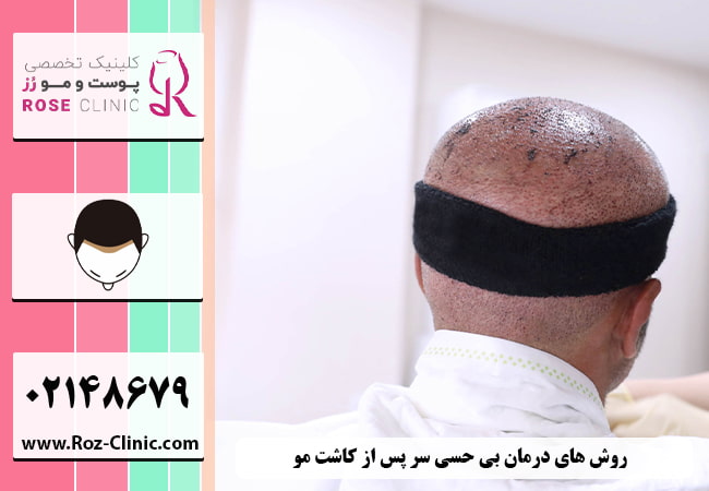 روش های درمان بی حسی سر پس از کاشت مو
