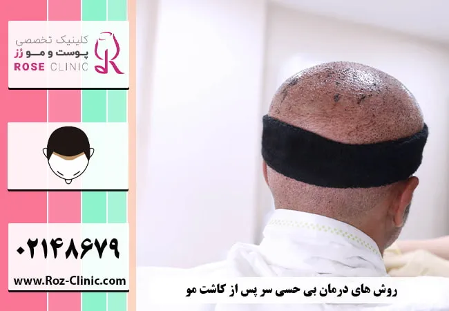 روش های درمان بی حسی سر پس از کاشت مو