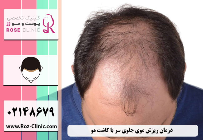 درمان ریزش موی جلوی سر با کاشت مو