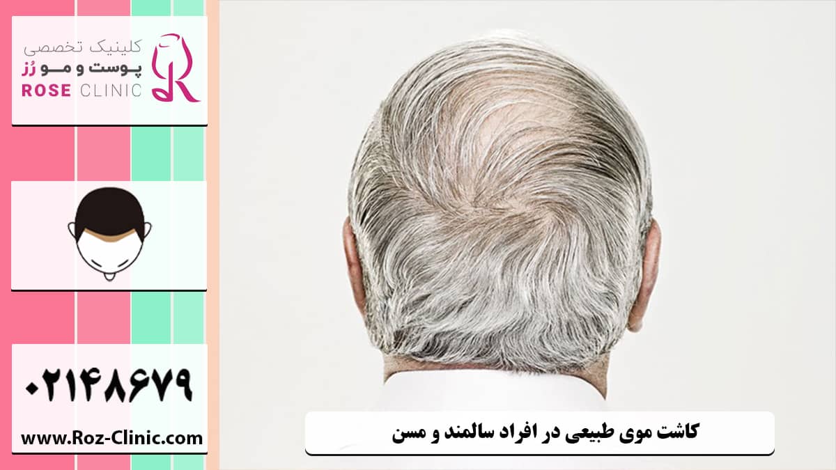 کاشت موی طبیعی در افراد مسن