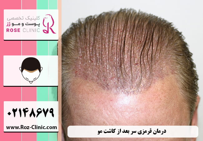 درمان قرمزی سر بعد از کاشت مو