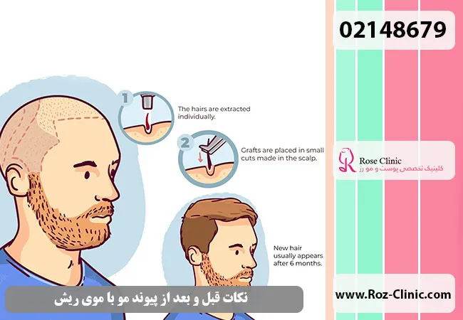 مراقبت قبل و بعد از پیوند موی سر از ریش