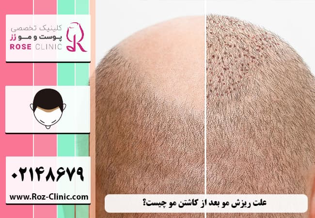 علت ریزش مو پس از پیوند فولیکولی مو