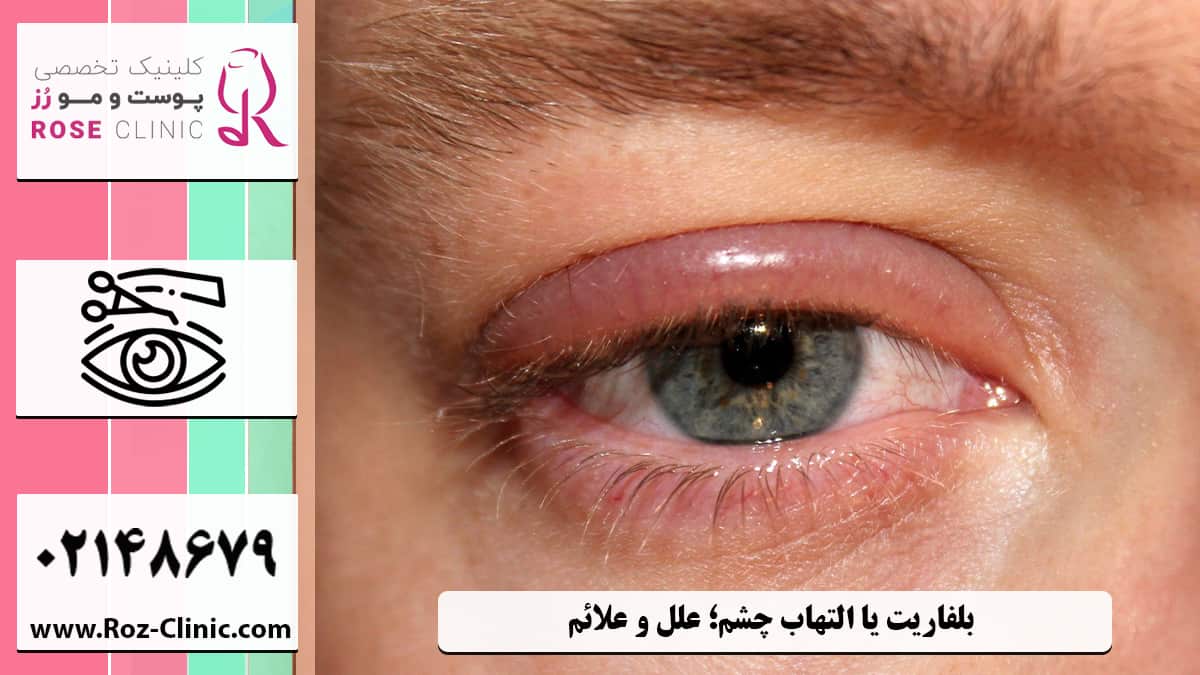 بلفاریت یا التهاب چشم