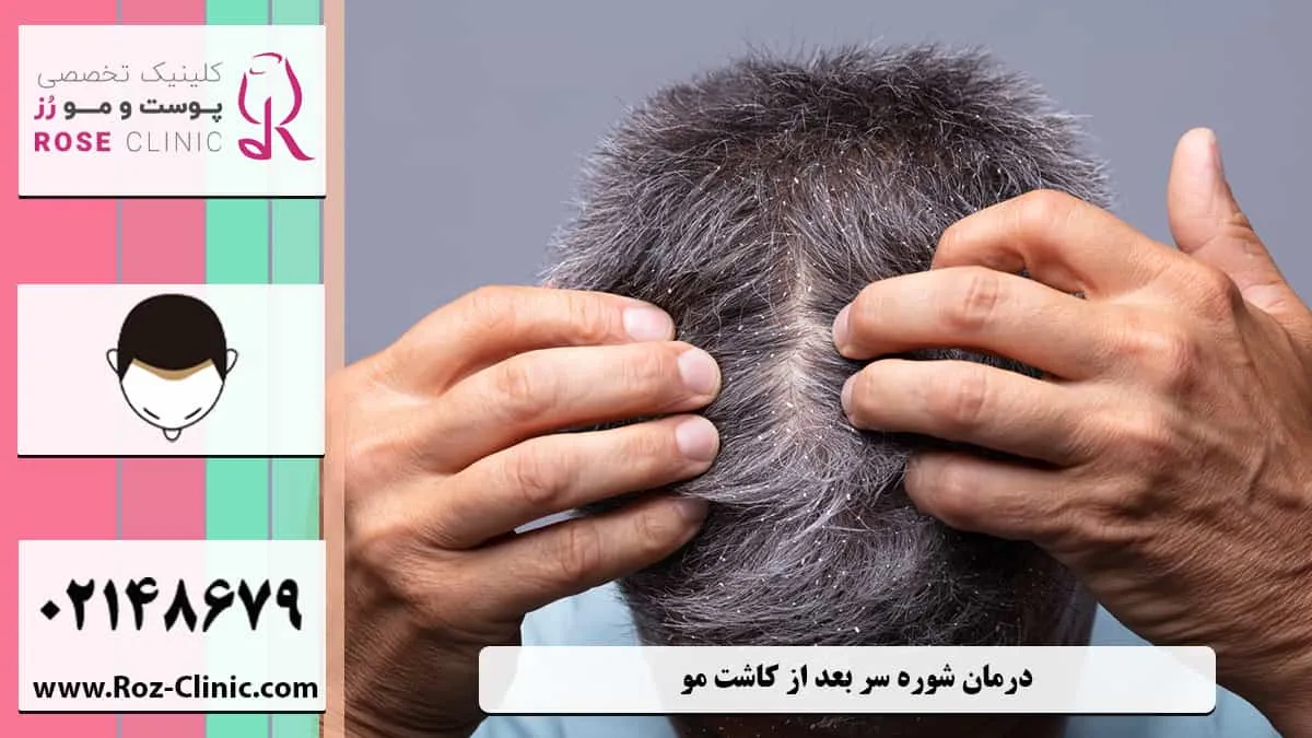 درمان شوره موی سر کاشته شده