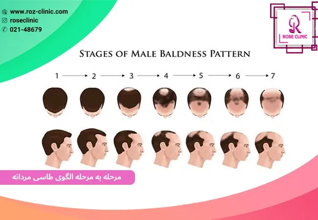 مراحل الگوی طاسی مردانه