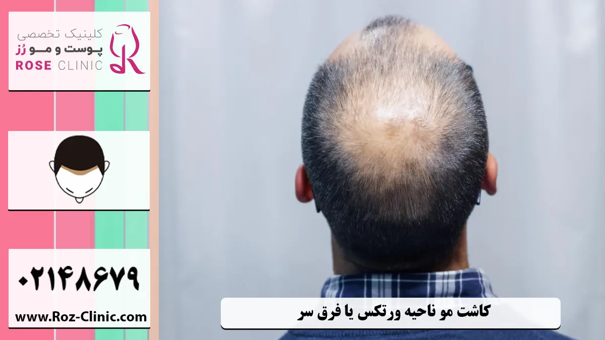 پیوند طبیعی مو در ناحیه فرق و پشت سر در کلینیک رز