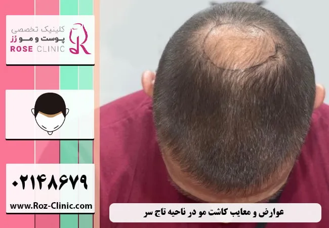 عوارض کاشت مو در ناحیه تاج سر