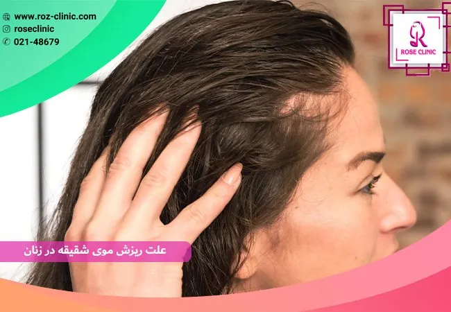 علت ریزش موی شقیقه در زنان