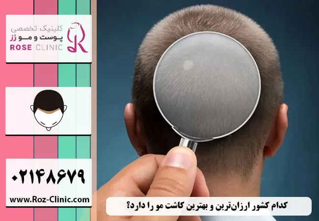 ارزان ترین هزینه کاشت مو در ایران 