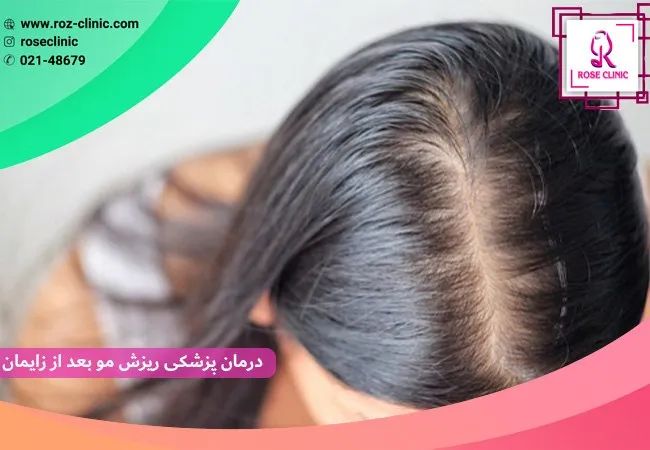 علل و درمان ریزش مو پس از زایمان