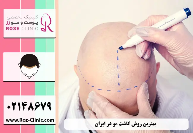 بهترین روش کاشت موی طبیعی در ایران
